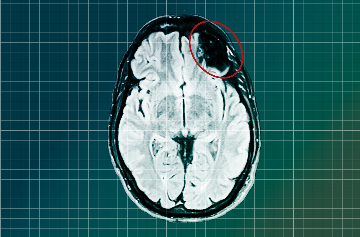 Brain Bank Helps Emerging Science Address Veterans’ Complex Injuries