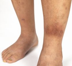 may2026-mom-cellulitis-internal.jpg