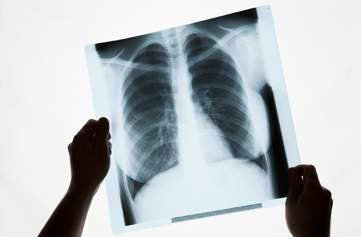 The VA Is Developing a 3-D Printed Artificial Lung
